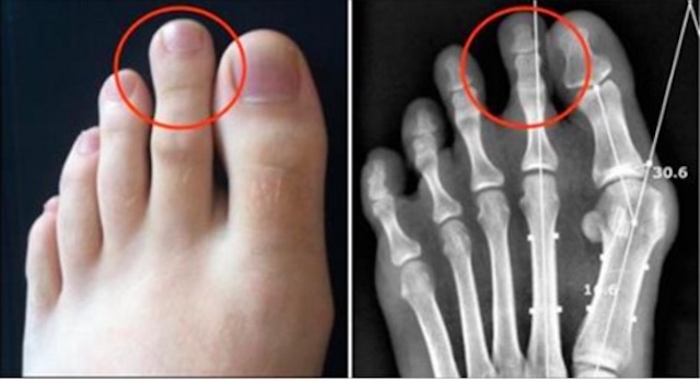 3人に1人 足の人差し指が長い ギリシャ型 が生涯負い続けるデメリットとは ラブリープレス